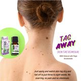 Tag Away Skin Tag Removal, 10mL (0.34 fl. oz. )